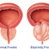 Prostat ve Prostat İltihabı