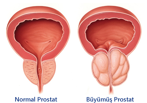 Prostat ve Prostat İltihabı