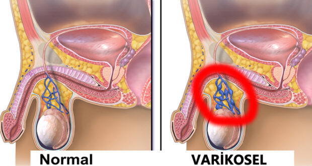 Varikosel